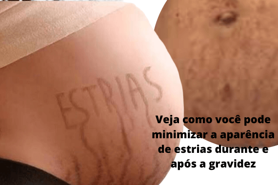 estrias na gravidez e no pós parto, dicas de como ameniza-las