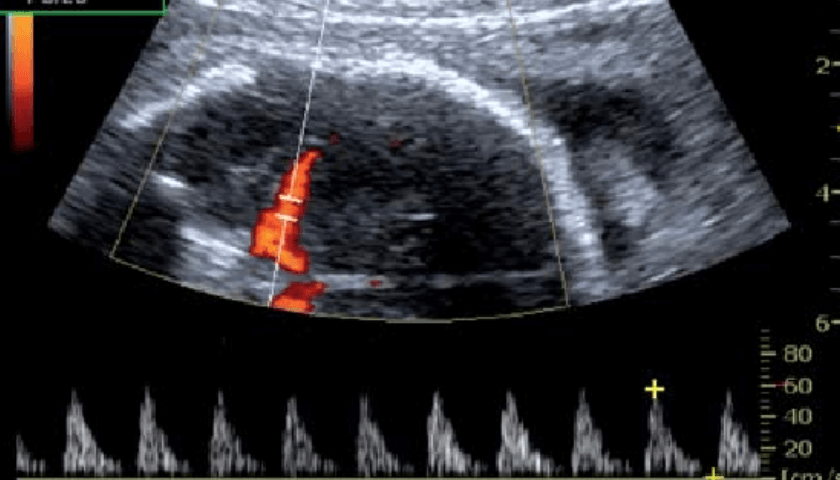 ultrassom com doppler