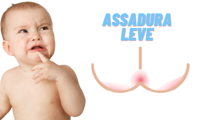 assadura bebe, bebê chorando