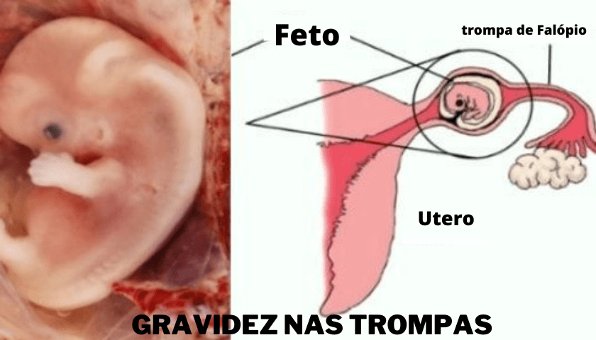 Gravidez Nas Trompas O Que é Quais Sintomas Gravidez Ectópica 